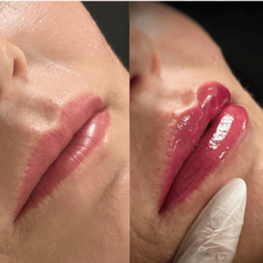 Preenchimento Labial 1ml